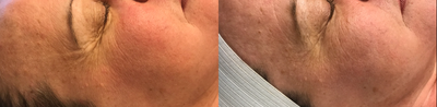 Chemical Peel before and after photo