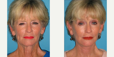 Facelift before and after photo