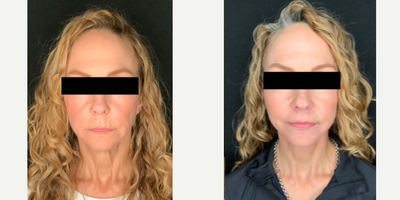 Facelift before and after photo