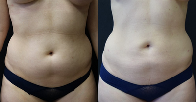 Liposuction before and after photo
