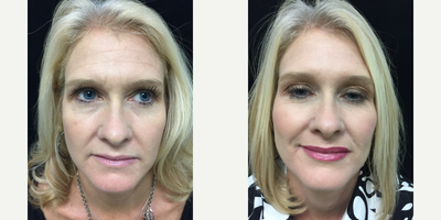 Liquid Facelift before and after photo