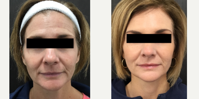 Xeomin before and after photo