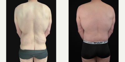 Body Lift before and after photo