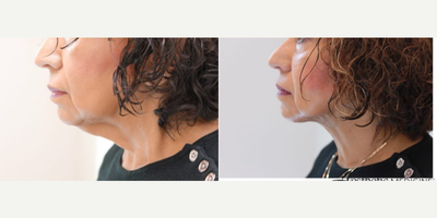 FaceTite before and after photo