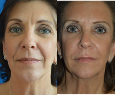 Juvederm before and after photo