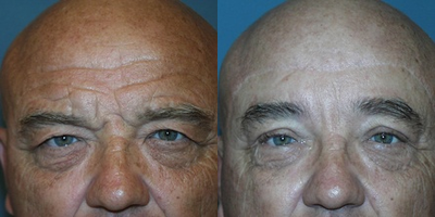 Brow Lift before and after photo