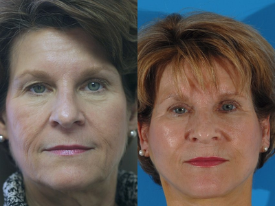 Eyelid Surgery before and after photo