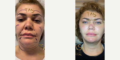 Facelift before and after photo