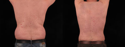 Liposuction before and after photo