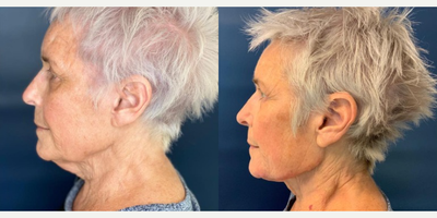 Botox before and after photo