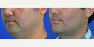 Buccal Fat Removal before and after photo