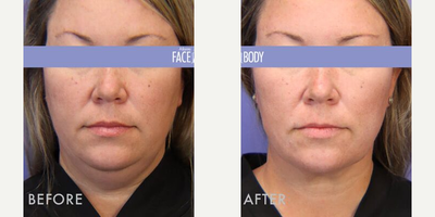 Chin Liposuction before and after photo