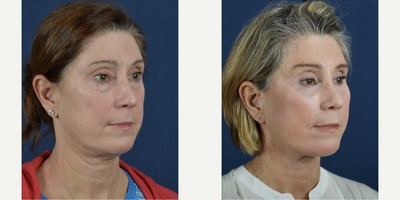 Facelift before and after photo