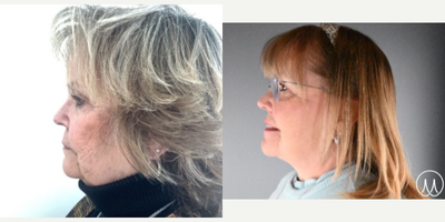 Facelift before and after photo