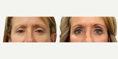 Facelift before and after photo