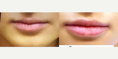Juvederm before and after photo