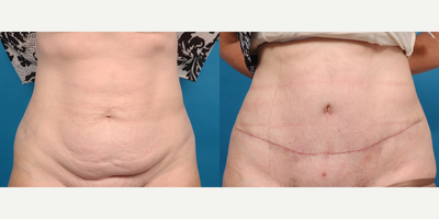 Tummy Tuck before and after photo