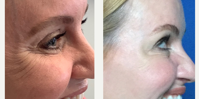 Botox before and after photo