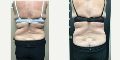 Emsculpt before and after photo