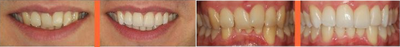 Invisalign before and after photo