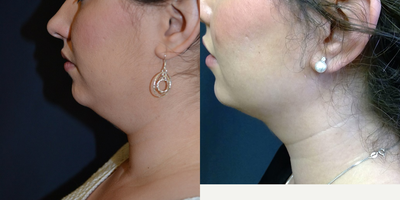 Liposculpture before and after photo