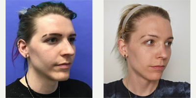 Rhinoplasty before and after photo