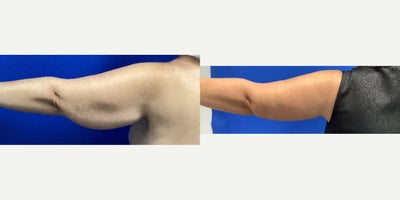 Arm Lift before and after photo