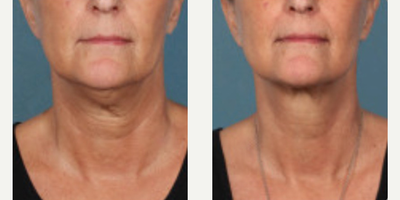 Kybella before and after photo