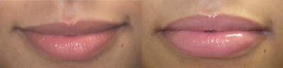 Lip Fillers before and after photo