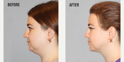 Liposuction before and after photo
