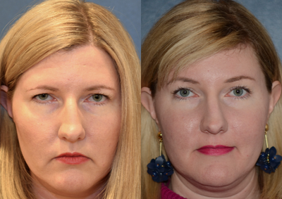 Brow Lift before and after photo