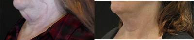 CoolSculpting before and after photo