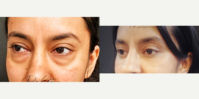 Eyelid Surgery before and after photo