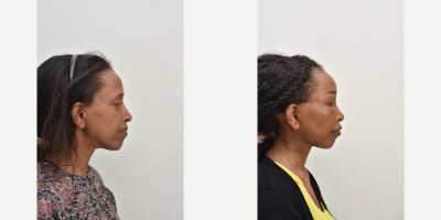 Facelift before and after photo