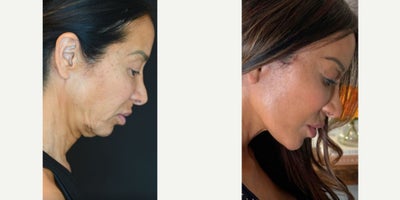 Facial Fat Transfer before and after photo
