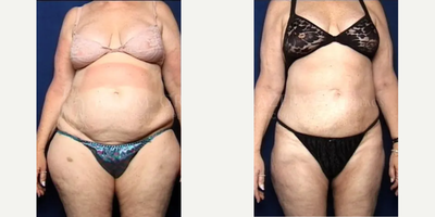 Liposuction before and after photo