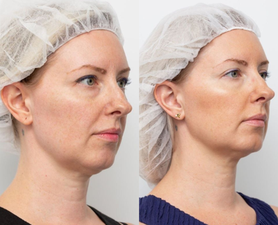 Thread Lift before and after photo