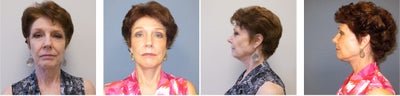 Facelift before and after photo
