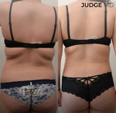 Liposculpture before and after photo