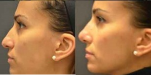 Rhinoplasty before and after photo