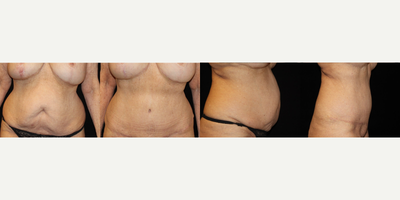 Tummy Tuck before and after photo