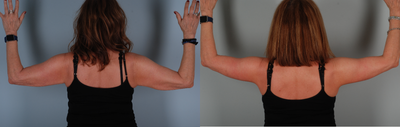 Arm Lift before and after photo