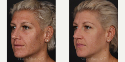 Fraxel Laser before and after photo