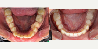 Invisalign before and after photo