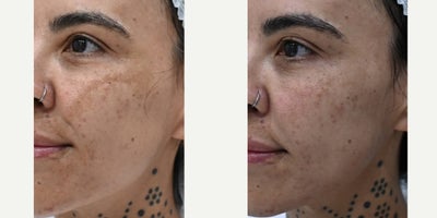 PicoWay before and after photo