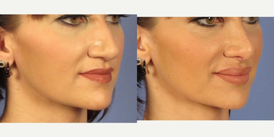 Juvederm before and after photo