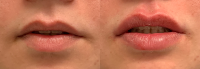 Lip Fillers before and after photo