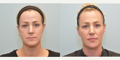 Dermal Fillers before and after photo
