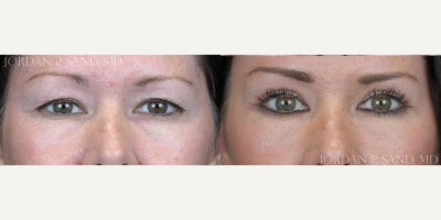 Eyelid Surgery before and after photo