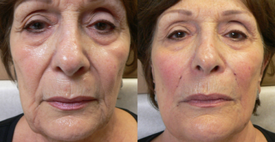 Juvederm before and after photo